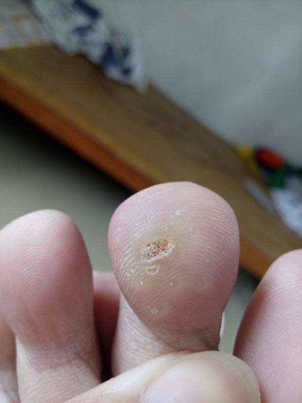中山治疗鸡眼去哪个皮肤病医院好,中山肤斗士皮肤科