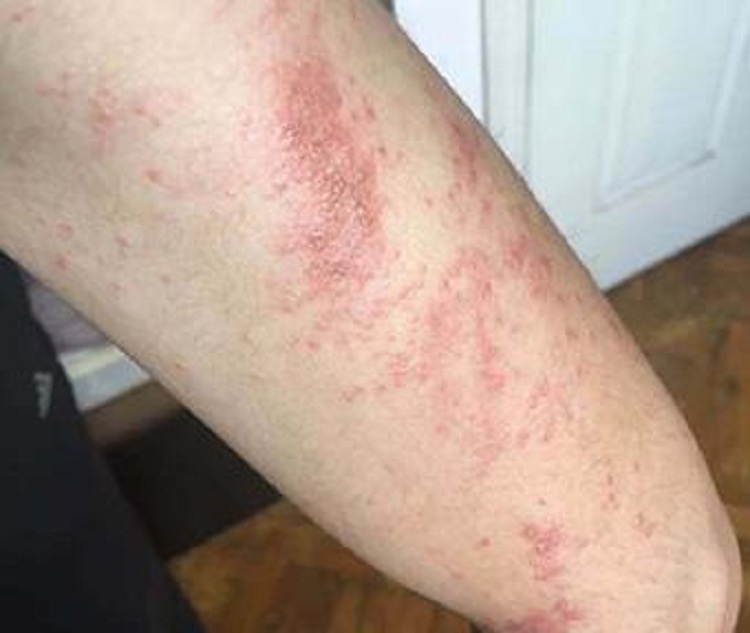 中山哪个皮肤病医院治疗湿疹专业,中山肤斗士皮肤科